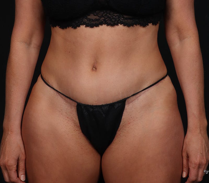 Abdominoplasty Before & After Gallery - Patient 203387 - Image 2