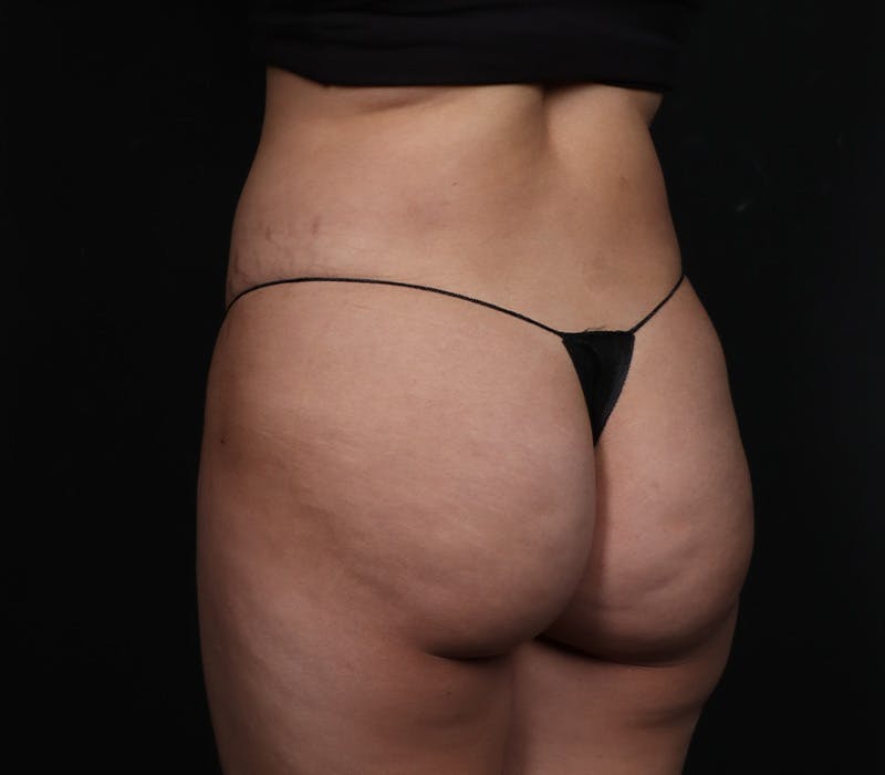 Liposuction Before & After Gallery - Patient 107873 - Image 4