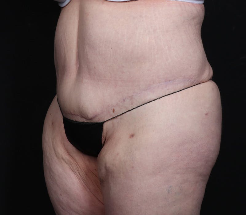 Abdominoplasty Before & After Gallery - Patient 216674 - Image 4