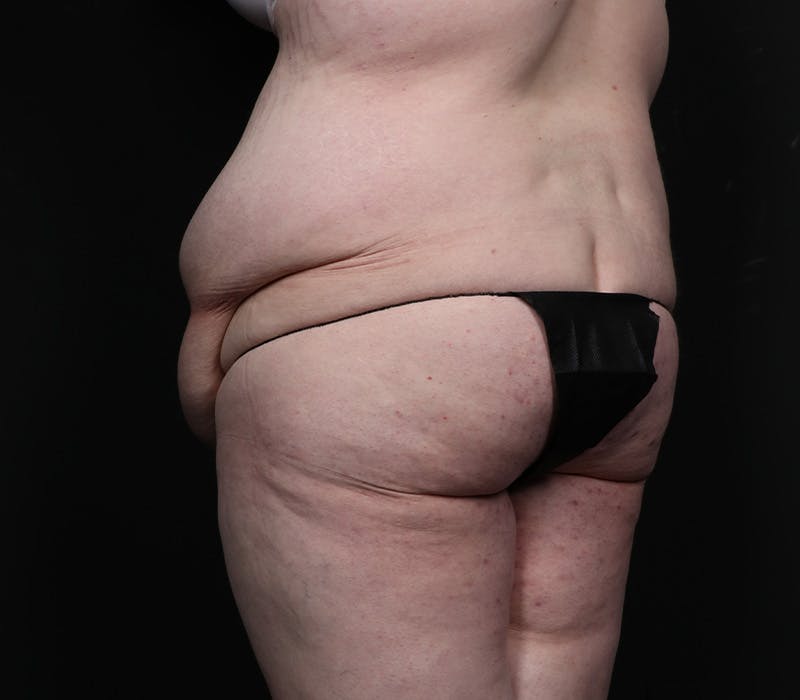 Abdominoplasty Before & After Gallery - Patient 216674 - Image 7