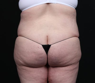 Brazilian Butt Lift Before & After Gallery - Patient 244830 - Image 2