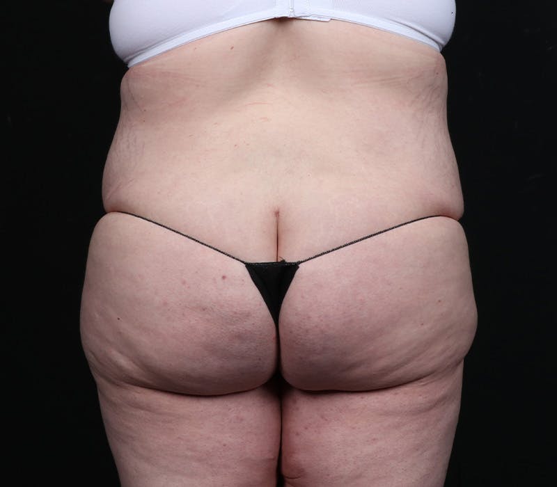 Abdominoplasty Before & After Gallery - Patient 216674 - Image 10