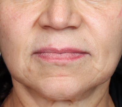 Lip Lift Before & After Gallery - Patient 186276 - Image 1