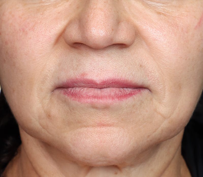 Lip Lift Before & After Gallery - Patient 186276 - Image 1