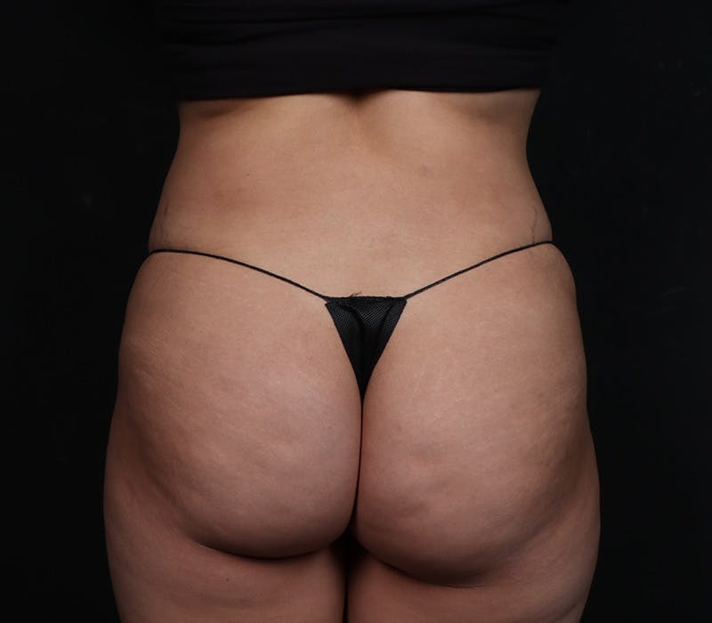 Liposuction Before & After Gallery - Patient 107873 - Image 2