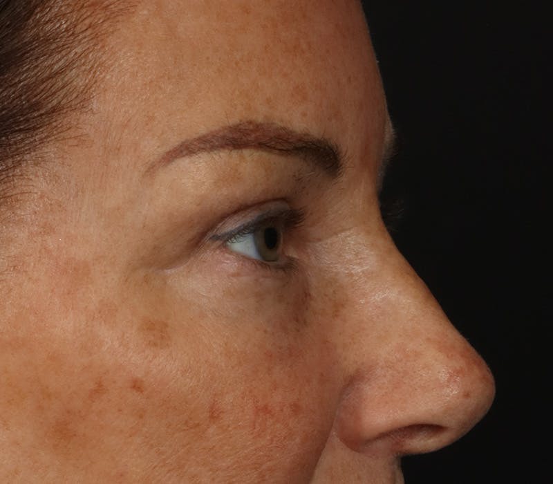 Blepharoplasty Before & After Gallery - Patient 321263 - Image 4