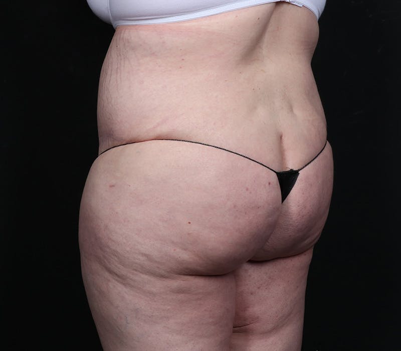 Abdominoplasty Before & After Gallery - Patient 216674 - Image 8