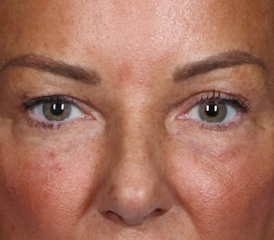 Blepharoplasty Before & After Gallery - Patient 321263 - Image 1