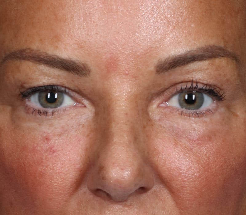 Blepharoplasty Before & After Gallery - Patient 321263 - Image 1