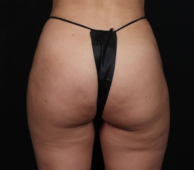 Brazilian Butt Lift Before & After Gallery - Patient 310559 - Image 2