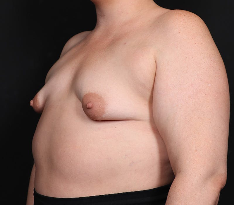 Breast Augmentation Before & After Gallery - Patient 428786 - Image 3