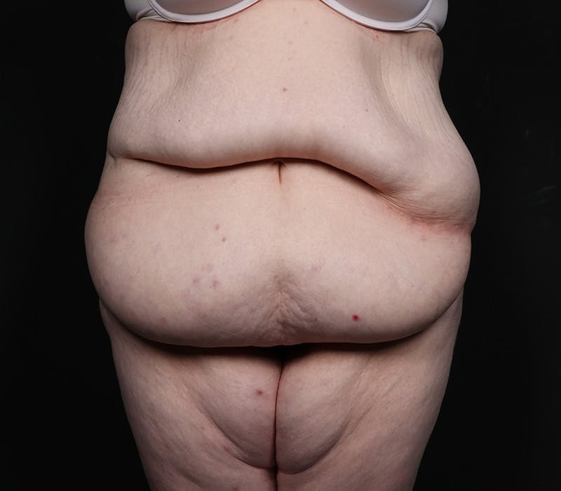 Abdominoplasty Before & After Gallery - Patient 216674 - Image 1