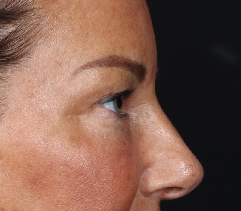 Blepharoplasty Before & After Gallery - Patient 321263 - Image 3
