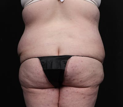Brazilian Butt Lift Before & After Gallery - Patient 244830 - Image 1