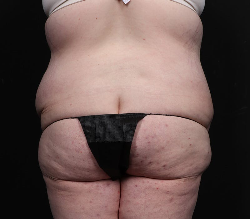 Abdominoplasty Before & After Gallery - Patient 216674 - Image 9