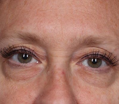 Blepharoplasty Before & After Gallery - Patient 336243 - Image 2