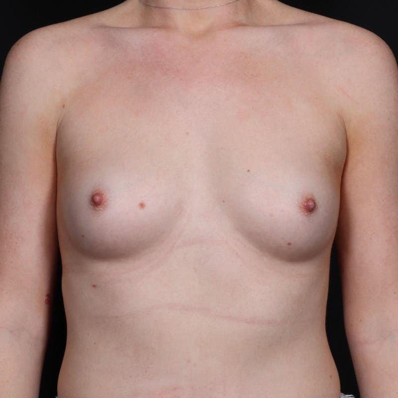 Breast Augmentation Before & After Gallery - Patient 125390 - Image 5