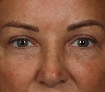 Blepharoplasty Before & After Gallery - Patient 321263 - Image 2
