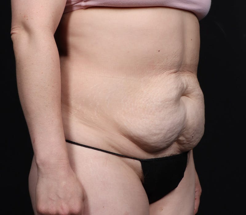 Abdominoplasty Before & After Gallery - Patient 247273 - Image 3