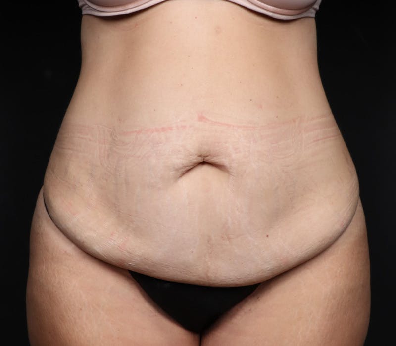Abdominoplasty Before & After Gallery - Patient 429407 - Image 3
