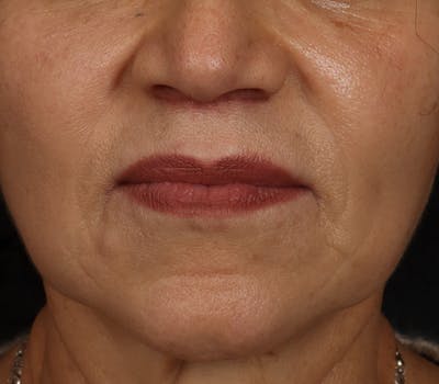 Lip Lift Before & After Gallery - Patient 186276 - Image 2
