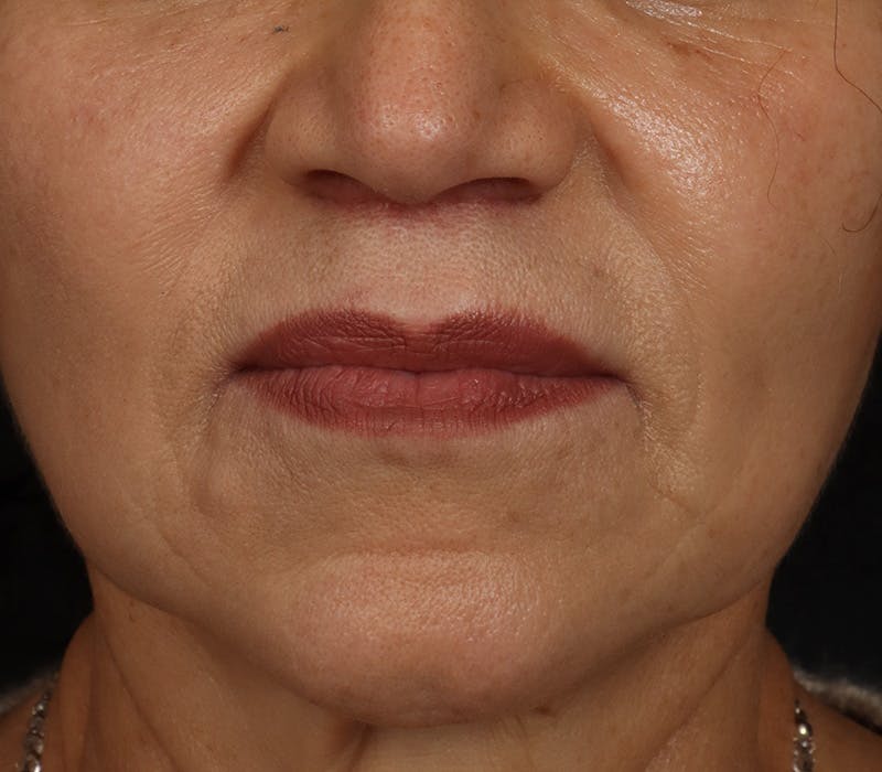 Lip Lift Before & After Gallery - Patient 186276 - Image 2