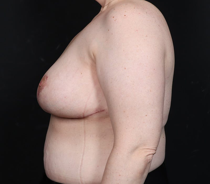 Breast Reduction with Lift Before & After Gallery - Patient 276300 - Image 6