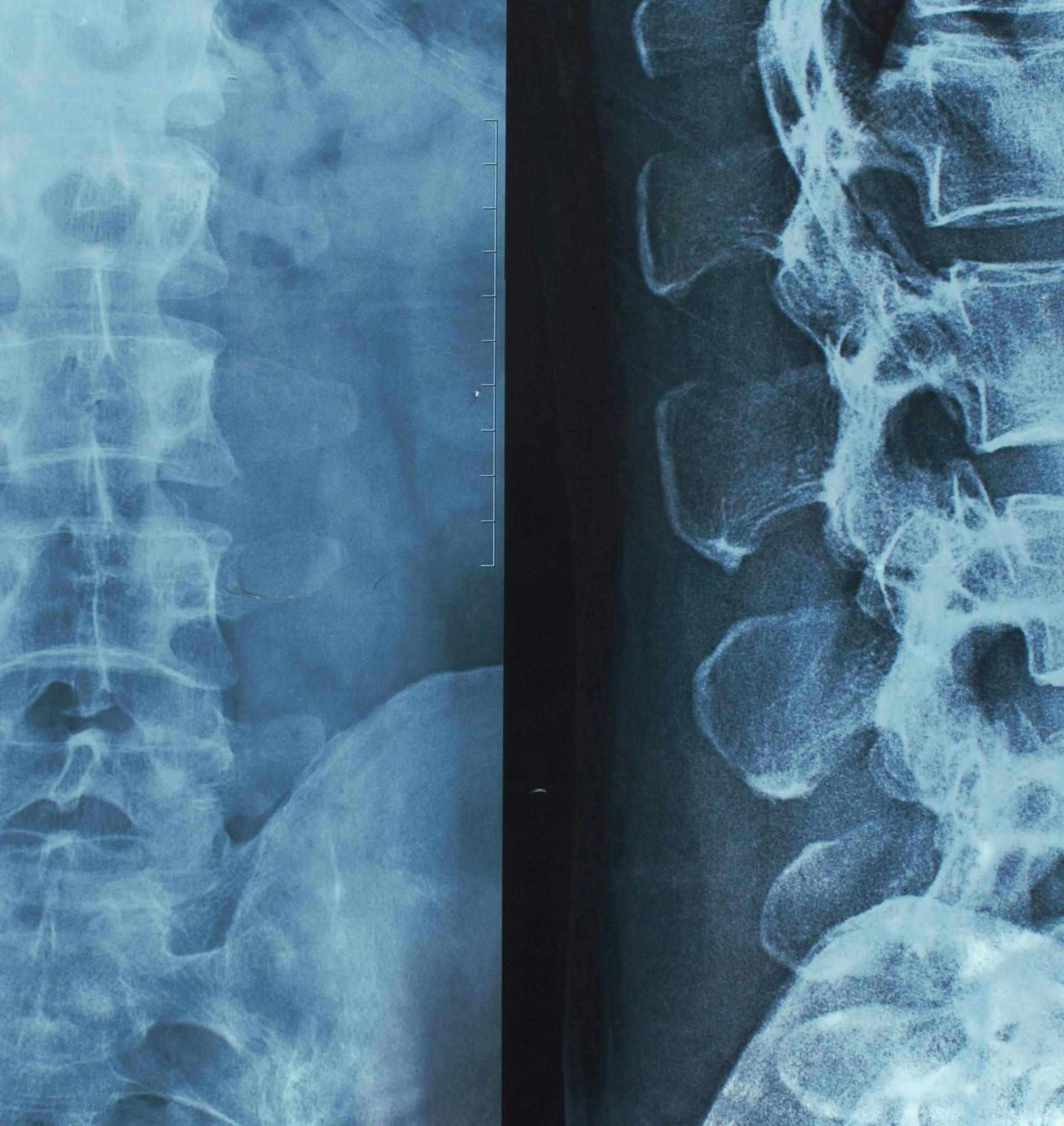 x-ray of curved spine