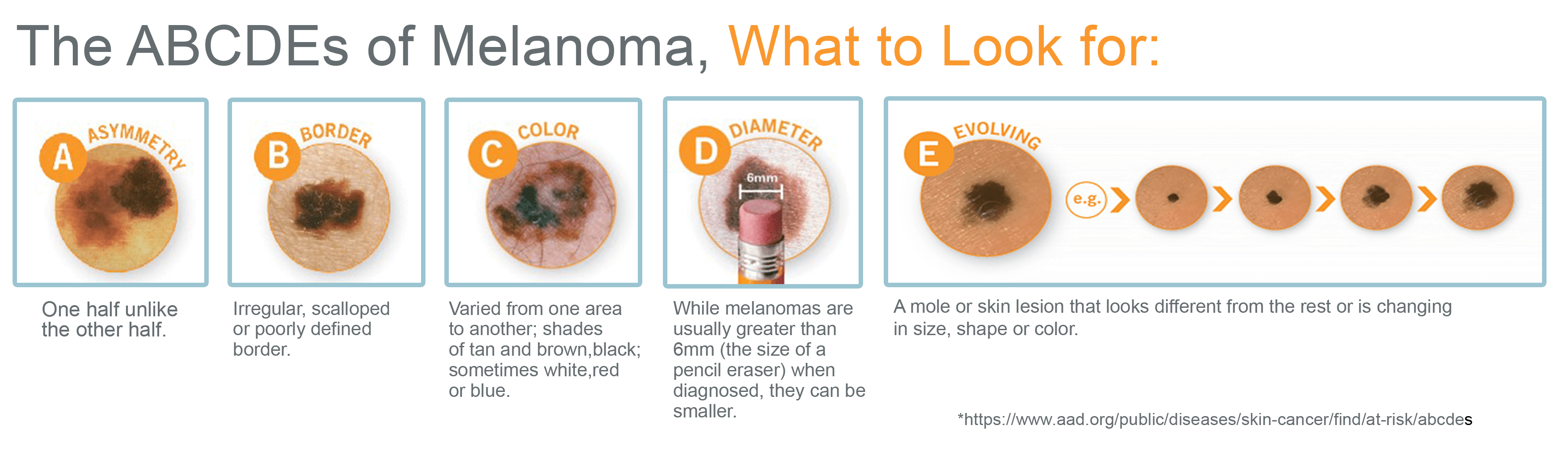 melanoma infographic