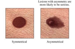 melanoma