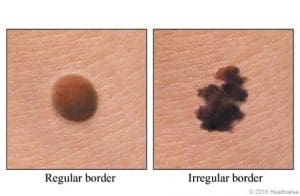 melanoma