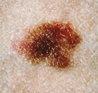melanoma