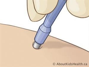 melanoma infographic