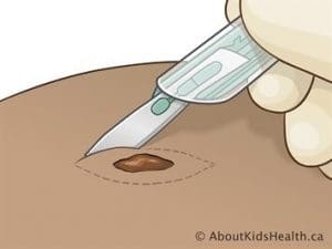 melanoma infographic
