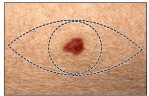 melanoma