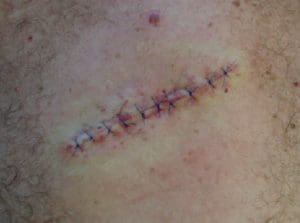 melanoma