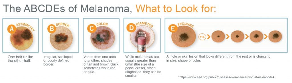 ABCDE'S OF MELANOMA