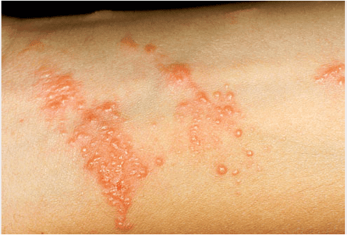 poison ivy rash