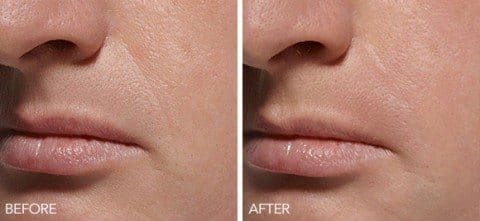 filler results