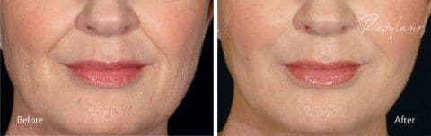 filler results
