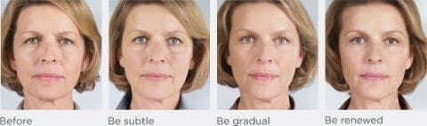 filler results