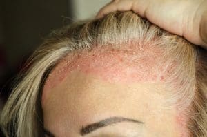 psoriasis