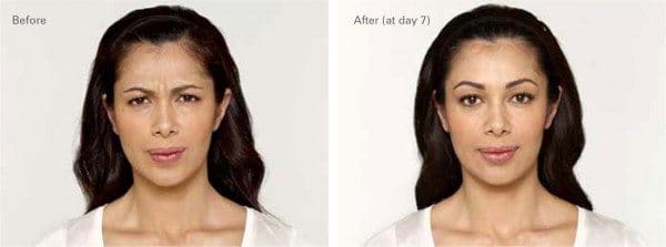 filler results
