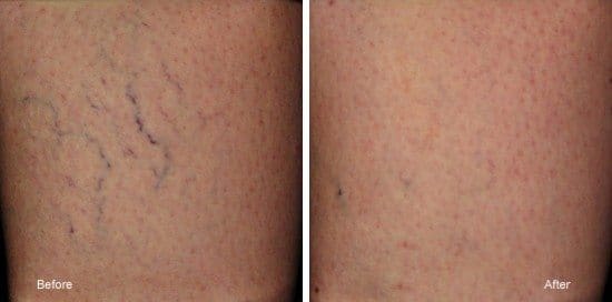Sclerotherapy results