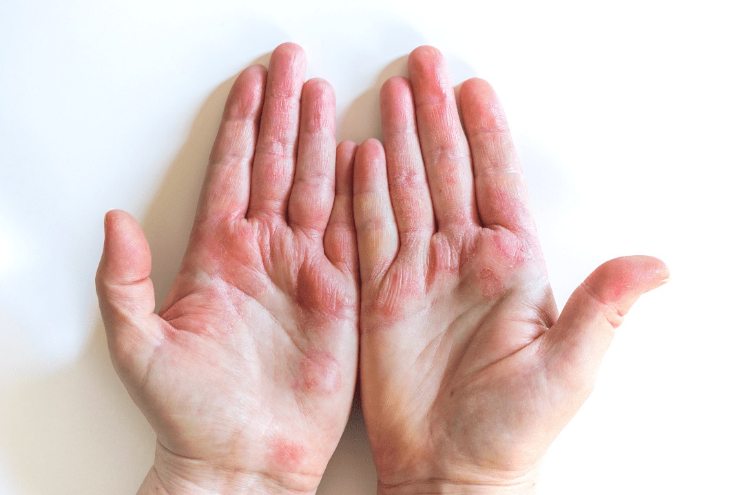 Dupixent: A Breakthrough in Eczema Treatment