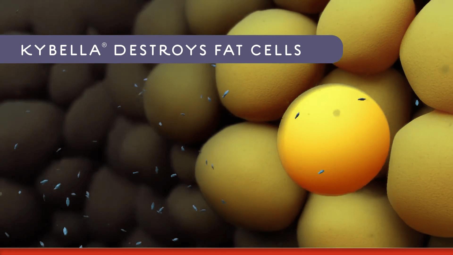 kybella video