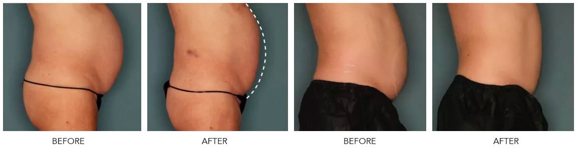 body contouring results
