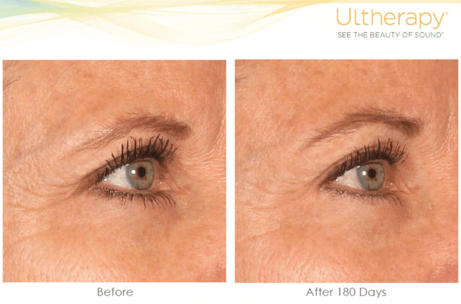 brow before and afters