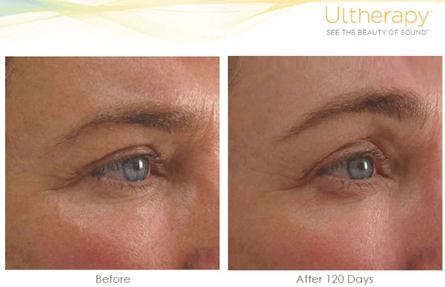 brow before and afters