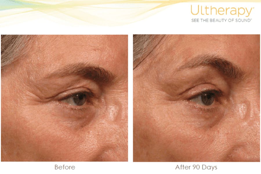 brow before and afters